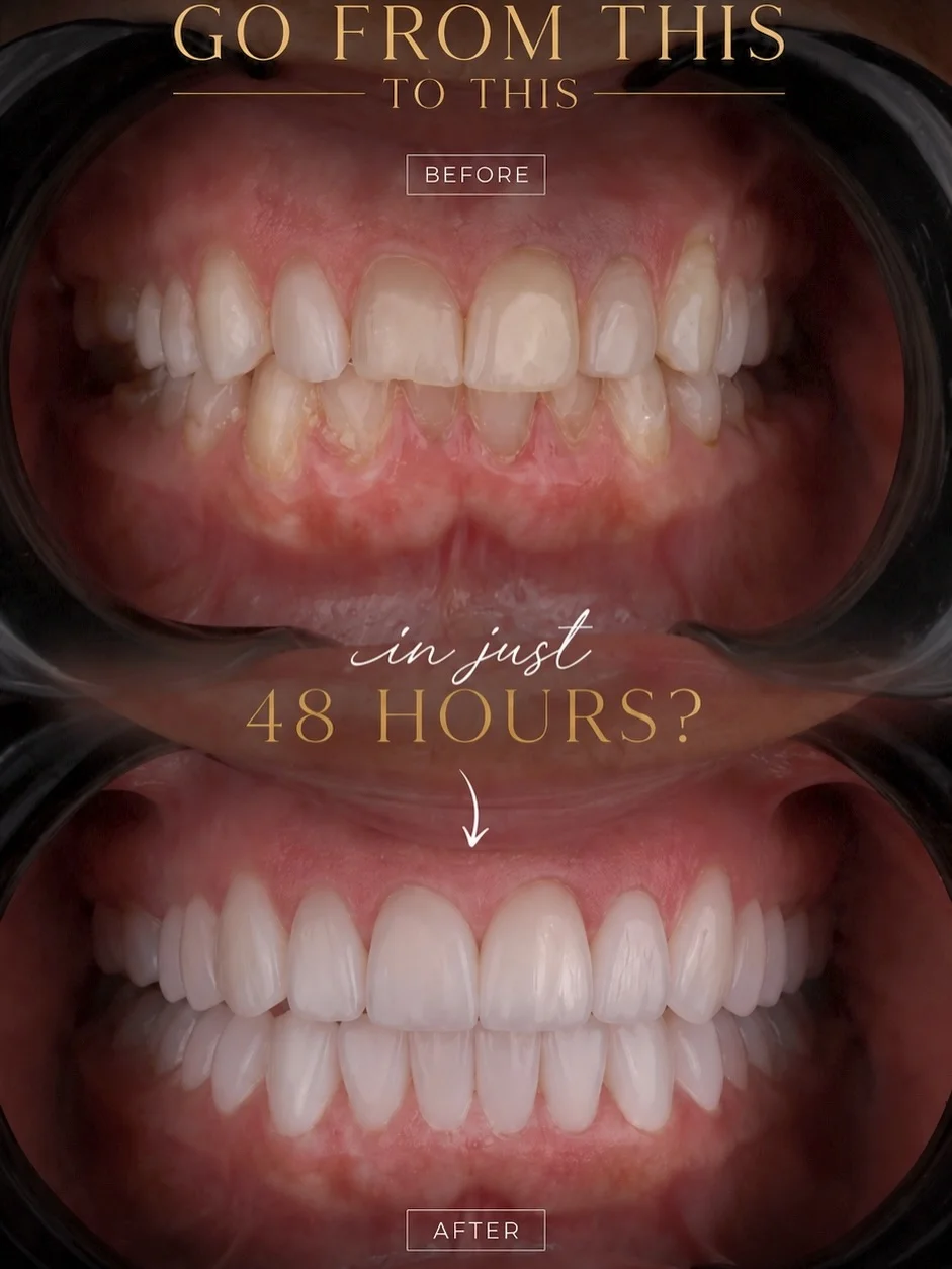Female patient before/after porcelain veneers